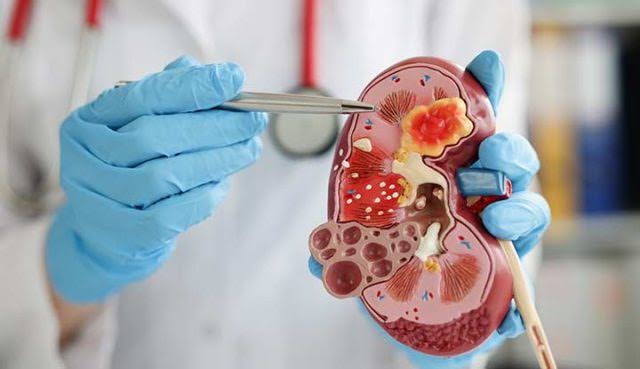 Nigeria has only 250 kidney specialists – Nephrologist